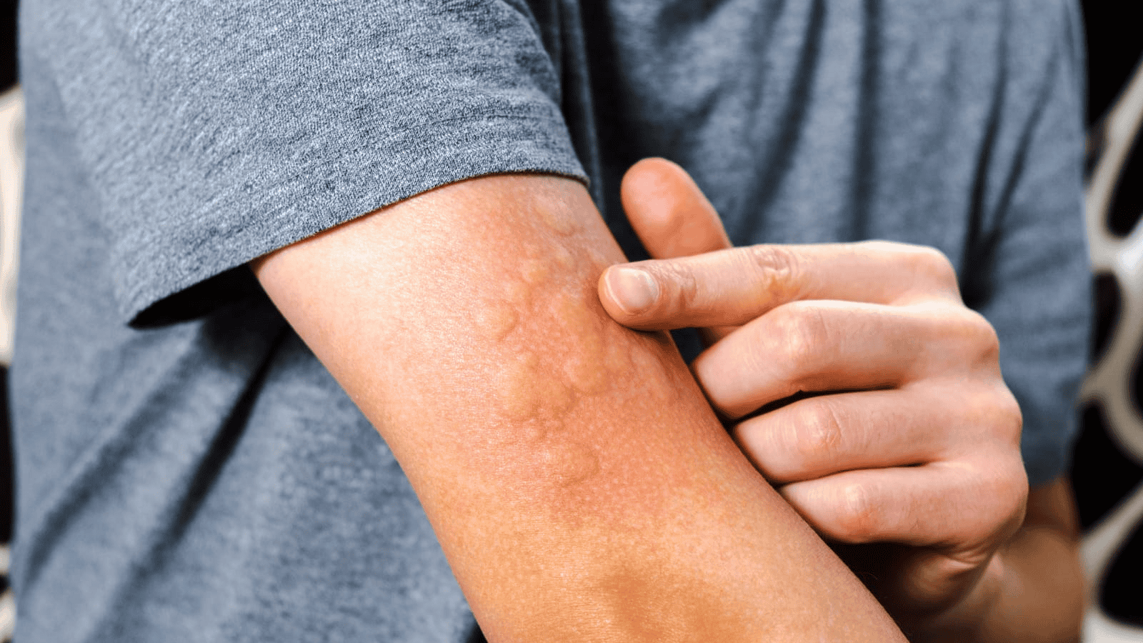 A person in a gray shirt points to a patch of raised, possibly irritated skin on their forearm, hinting at alcohol intolerance signs. The skin appears textured and slightly discolored compared to the surrounding area.