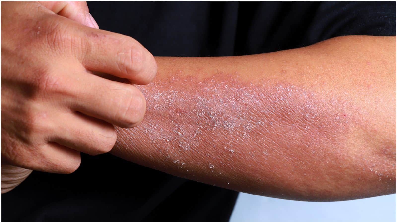 A person scratches the dry, flaky skin on their arm. The skin appears irritated and red in some areas. The individual is wearing a dark-colored shirt.